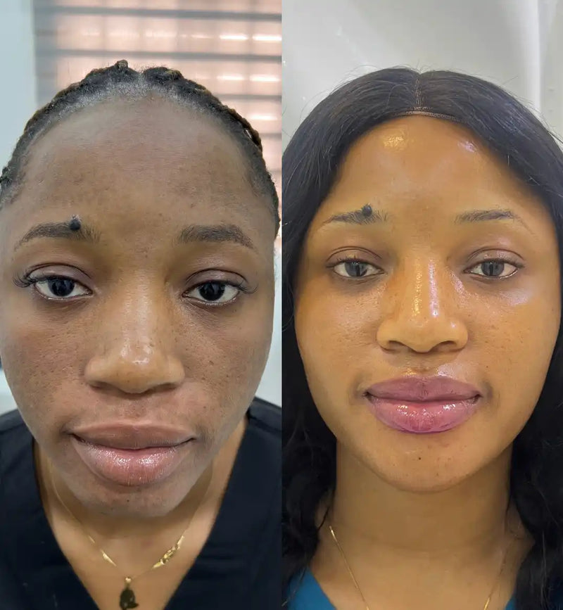 A split image showing a woman’s face before and after a cosmetic treatment.