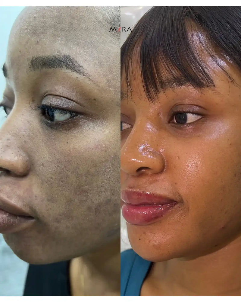 A split image showing a woman’s face before and after a skin treatment, highlighting improved skin texture and tone.