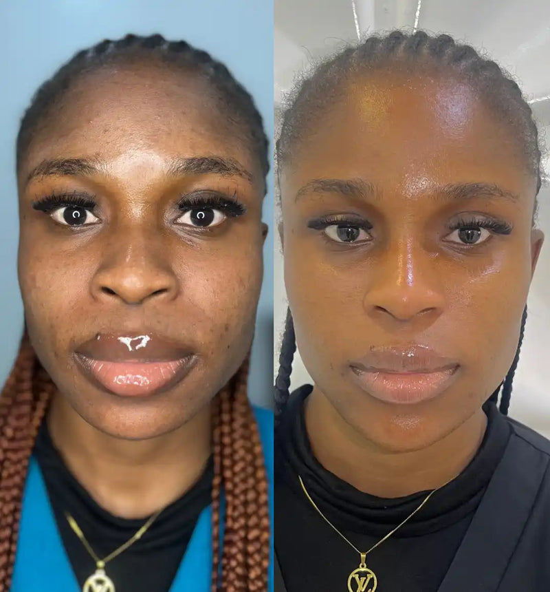A woman’s face before and after a cosmetic treatment.