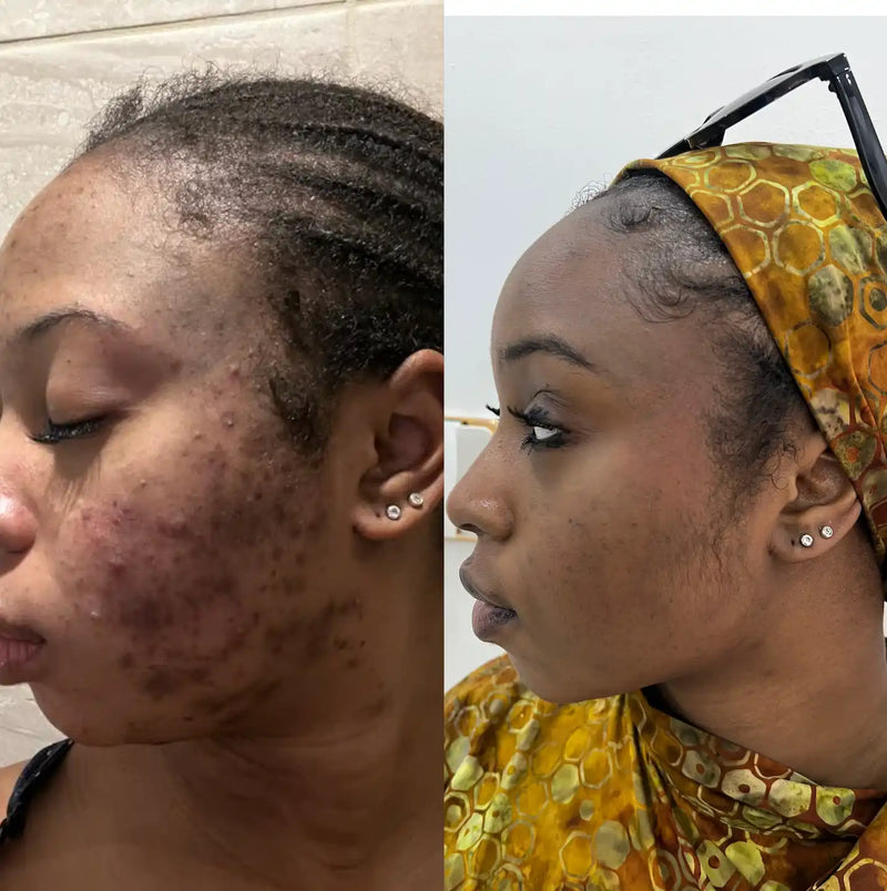 Before and after comparison showing skin condition improvement on a person’s face.