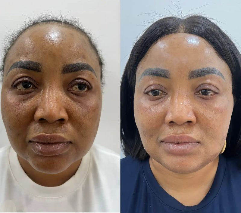 Side-by-side comparison of a woman’s face before and after a cosmetic procedure.