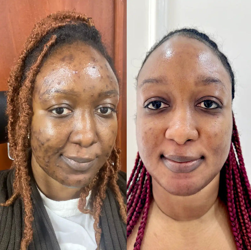 Side-by-side comparison of a woman’s face showing skin condition improvement.